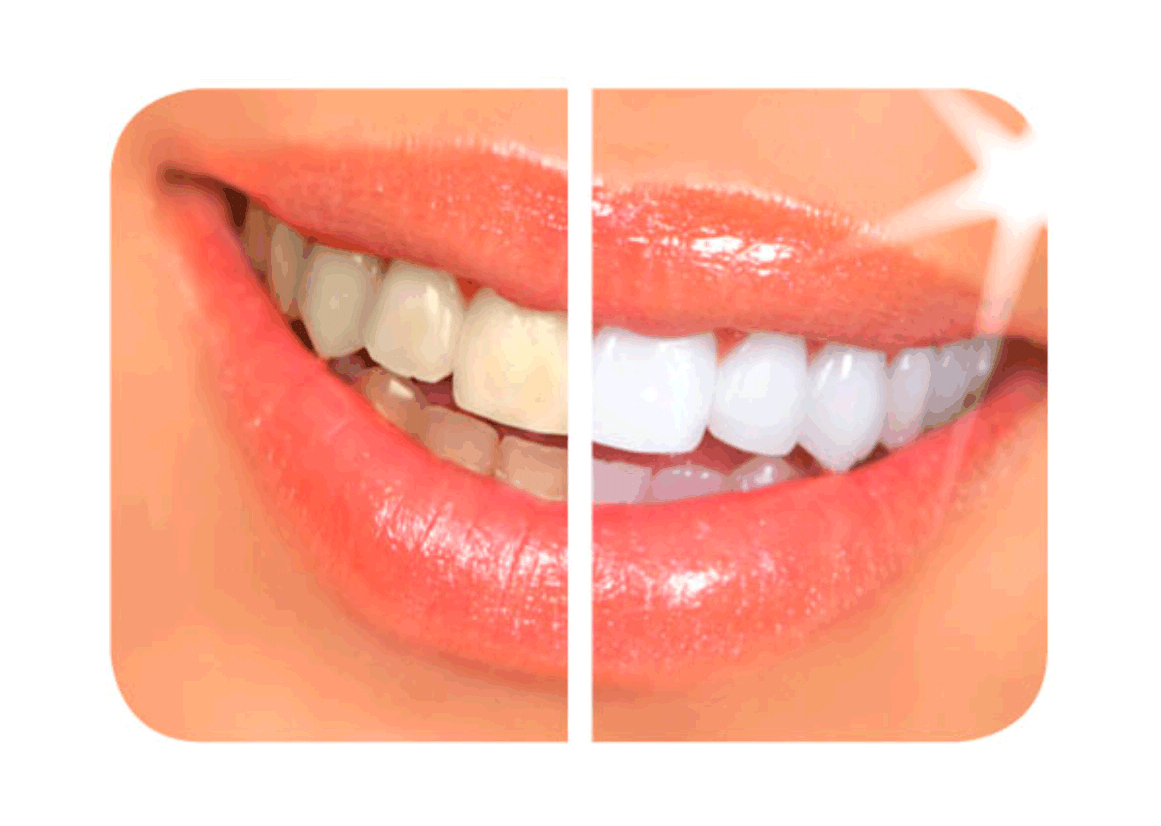 Davinci Teeth Whitening