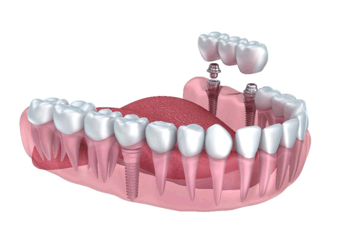 Dental Implants